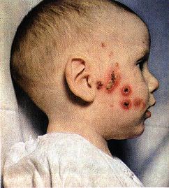 Impetigo